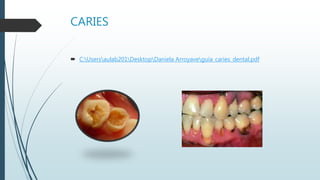 CARIES
 C:Usersaulab201DesktopDaniela Arroyaveguia_caries_dental.pdf
 