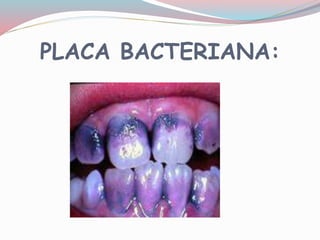 PLACA BACTERIANA:
 