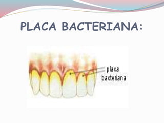PLACA BACTERIANA:
 
