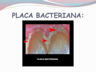 PLACA BACTERIANA:
 