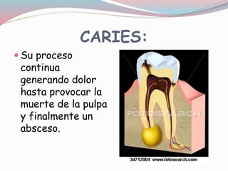 CARIES:
 Su proceso
continua
generando dolor
hasta provocar la
muerte de la pulpa
y finalmente un
absceso.
 