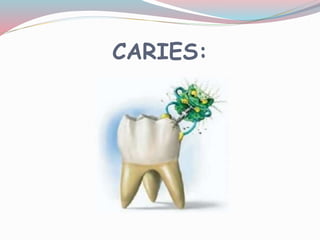 CARIES:
 