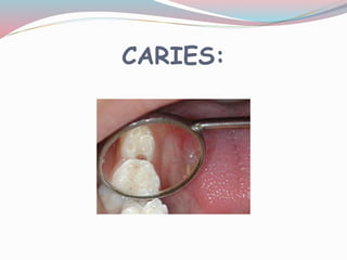 CARIES:
 