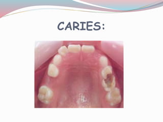 CARIES:
 