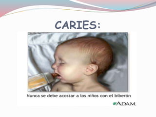 CARIES:
 