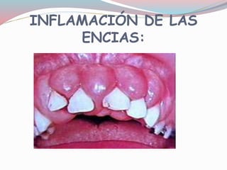 INFLAMACIÓN DE LAS
ENCIAS:
 
