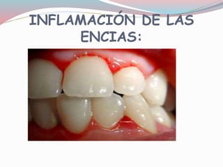 INFLAMACIÓN DE LAS
ENCIAS:
 