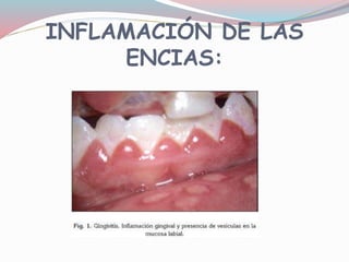 INFLAMACIÓN DE LAS
ENCIAS:
 