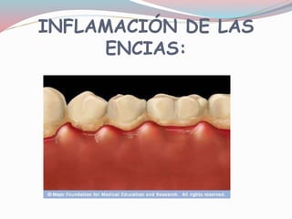 INFLAMACIÓN DE LAS
ENCIAS:
 