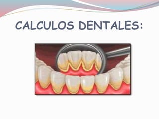 CALCULOS DENTALES:
 