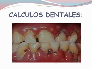 CALCULOS DENTALES:
 