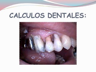 CALCULOS DENTALES:
 