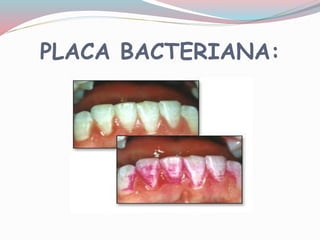 PLACA BACTERIANA:
 