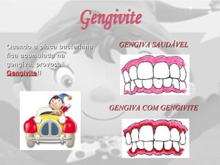 Quando a placa bacterianaQuando a placa bacteriana
fica acumulada nafica acumulada na
gengiva, provocagengiva, provoca
GengiviteGengivite !!!!
GENGIVA SAUDÁVELGENGIVA SAUDÁVEL
GENGIVA COM GENGIVITEGENGIVA COM GENGIVITE
 