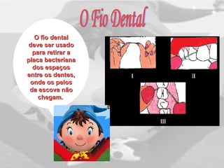 O fio dentalO fio dental
deve ser usadodeve ser usado
para retirar apara retirar a
placa bacterianaplaca bacteriana
dos espaçosdos espaços
entre os dentes,entre os dentes,
onde os pelosonde os pelos
da escova nãoda escova não
chegam.chegam.
 