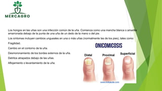 Los hongos en las uñas son una infección común de la uña. Comienza como una mancha blanca o amarilla
amarronada debajo de la punta de una uña de un dedo de la mano o del pie.
Los síntomas incluyen cambios ungueales en una o más uñas (normalmente las de los pies), tales como:
Fragilidad.
Cambio en el contorno de la uña.
Desmoronamiento de los bordes externos de la uña.
Detritos atrapados debajo de las uñas.
Aflojamiento o levantamiento de la uña.
 