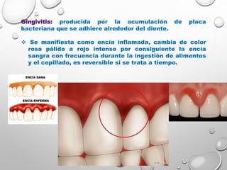 Gingivitis: producida por la acumulación de placa
bacteriana que se adhiere alrededor del diente.
 Se manifiesta como encía inflamada, cambia de color
rosa pálido a rojo intenso por consiguiente la encía
sangra con frecuencia durante la ingestión de alimentos
y el cepillado, es reversible si se trata a tiempo.
 