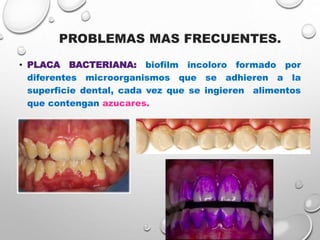 PROBLEMAS MAS FRECUENTES.
• PLACA BACTERIANA: biofilm incoloro formado por
diferentes microorganismos que se adhieren a la
superficie dental, cada vez que se ingieren alimentos
que contengan azucares.
 