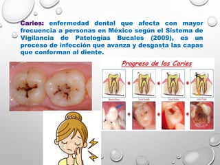Caries: enfermedad dental que afecta con mayor
frecuencia a personas en México según el Sistema de
Vigilancia de Patologías Bucales (2009), es un
proceso de infección que avanza y desgasta las capas
que conforman al diente.
 