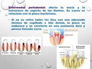 Enfermedad periodontal: afecta la encía y la
estructura de soporte de los dientes. Su causa se
relaciona con la placa bacteriana.
• Si no se retira todos los días con una adecuada
técnica de cepillado e hilo dental, la placa se
endurece y se convierte en una sustancia dura y
porosa llamada sarro.
 