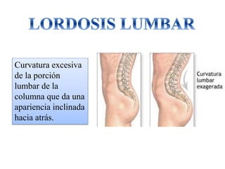 Curvatura excesiva
de la porción
lumbar de la
columna que da una
apariencia inclinada
hacia atrás.
 