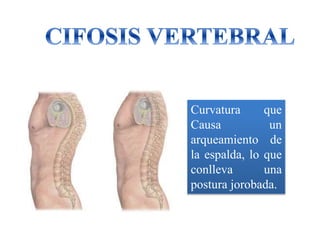 Curvatura que
Causa un
arqueamiento de
la espalda, lo que
conlleva una
postura jorobada.
 