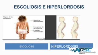 ESCOLIOSIS HIPERLORDOSIS
 
