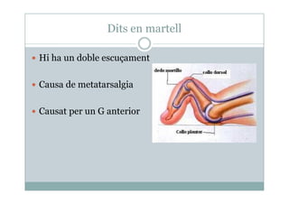 Dits en martell
Hi ha un doble escuçament
Causa de metatarsalgia
Causat per un G anterior
 