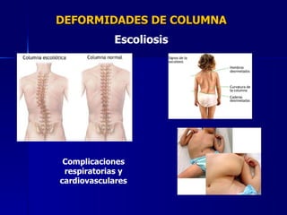 DEFORMIDADES DE COLUMNA Escoliosis Complicaciones respiratorias y cardiovasculares 