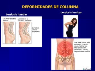 DEFORMIDADES DE COLUMNA Lordosis lumbar Lordosis lumbar 