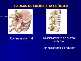 CAUSAS DE LUMBALGIA CRÓNICA Columna normal Desplazamiento de cuerpo vertebral Por mecanismo de rotación 