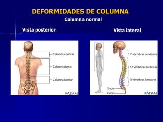 DEFORMIDADES DE COLUMNA Columna normal Vista posterior Vista lateral 