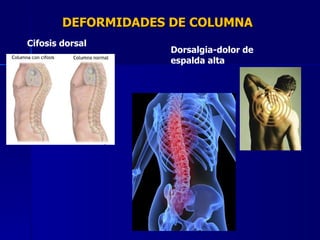 DEFORMIDADES DE COLUMNA Cifosis dorsal Dorsalgia-dolor de espalda alta 