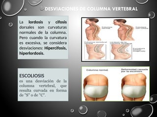 La lordosis y cifosis
dorsales son curvaturas
normales de la columna.
Pero cuando la curvatura
es excesiva, se considera
desviaciones: Hipercifosis,
hiperlordosis.
DESVIACIONES DE COLUMNA VERTEBRAL
ESCOLIOSIS
es una desviación de la
columna vertebral, que
resulta curvada en forma
de "S" o de "C".
 