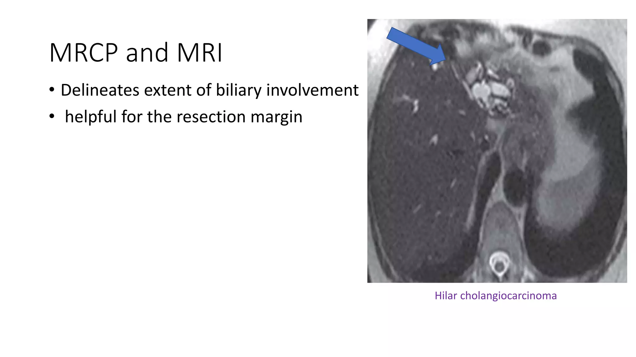 CHOLANGIOCARCINOMA | PPTX