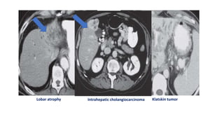 Lobar atrophy Klatskin tumor
Intrahepatic cholangiocarcinoma
 