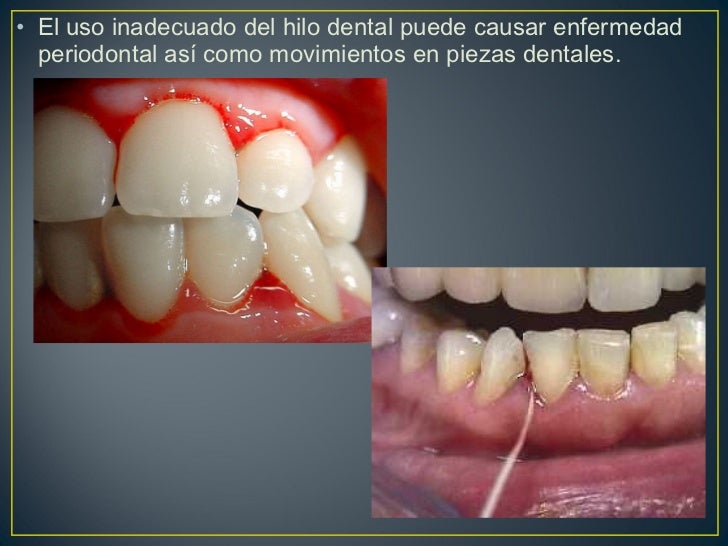 Usar Hilo Dental Es Bueno O Malo