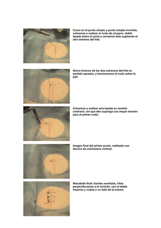 Como en el punto simple y punto simple invertido,
volvemos a realizar el nudo de cirujano: doble
lazada sobre el porta y cerramos éste sujetando el
otro extremo del hilo.




Ahora tiramos de los dos extremos del hilo en
sentido opuesto, y tensionamos el nudo sobre la
piel.




Volvemos a realizar otra lazada en sentido
contrario, sin que ello suponga una mayor tensión
para el primer nudo.




Imagen final del primer punto, realizado con
técnica de colchonero vertical.




Resultado final: bordes evertidos, hilos
perpendiculares a la incisión, con el doble
trayecto y nudos a un lado de la misma.
 