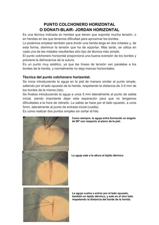 PUNTO COLCHONERO HORIZONTAL
            O DONATI-BLAIR- JORDAN HORIZONTAL
Es una técnica indicada en heridas que tienen que soportar mucha tensión, o
en heridas en las que tenemos dificultad para aproximar los bordes.
Lo podemos emplear también para dividir una herida larga en dos mitades y, de
esta forma, disminuir la tensión que ha de soportar. Más tarde, se utiliza en
cada una de las mitades resultantes otro tipo de técnica más simple.
El punto colchonero horizontal proporciona una buena eversión de los bordes y
previene la dehiscencia de la sutura.
Es un punto muy estético, ya que las líneas de tensión van paralelas a los
bordes de la herida, y normalmente no deja marcas horizontales.

Técnica del punto colchonero horizontal.
Se inicia introduciendo la aguja en la piel de manera similar al punto simple,
saliendo por el lado opuesto de la herida, respetando la distancia de 3-5 mm de
los bordes de la misma (ida).
Se finaliza introduciendo la aguja a unos 5 mm lateralmente al punto de salida
inicial, siendo importante dejar esta separación para que no tengamos
dificultades a la hora de retirarlo. La salida se hace por el lado opuesto, a unos
5mm, lateralmente al punto de entrada inicial (vuelta).
Es como realizar dos puntos simples sin cortar el hilo.

                                   Como siempre, la aguja entra formando un ángulo
                                   de 90º con respecto al plano de la piel.




                                   La aguja sale a la altura el tejido dérmico




                                   La aguja vuelve a entrar por el lado opuesto,
                                   también en tejido dérmico, y sale en el otro lado
                                   respetando la distancia del borde de la herida.
 