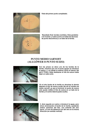 Vista del primer punto completado.




          Resultado final: bordes evertidos, hilos paralelos
          a la incisión y nudos (como en todas las técnicas
          de punto discontinuo) a un lado de la herida.




  PUNTO MEDIO SARNOFF
(ALLGÖWER O PUNTO SUIZO)
       Con las pinzas se eleva uno de los bordes de la
       herida, mientras que con el porta agujas se introduce
       la aguja a 1 cm desde el exterior hacia el interior (de
       piel a TCSC). Debe deslizarse el hilo de sutura hasta
       dejar un cabo corto




       En el otro borde de la herida se atraviesa la dermis
       dejando el hilo de sutura oculto (de ahí el nombre de
       medio sarnoff, ya que al terminar el punto de sutura
       solo queda visible el hilo de sutura en un lado de la
       herida y el contra lateral queda oculto).




        3. Acto seguido se vuelve a introducir la aguja, pero
        ahora atravesando el borde de la herida, quedando
        ambos extremos del hilo, uno enfrente del otro
        aprox. a 9 mm de distancia uno del otro en la misma
        dirección (en sentido vertical).
 