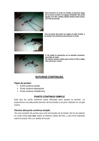 Para terminar el nudo se enrolla el extremo largo
                                     de la sutura (unido a la aguja) alrededor del porta
                                     agujas con dos vueltas (doble lazada sobre porta,
                                     con hilo proximal).




                                  Con la punta del porta se sujeta el cabo suelto, y
                                  se estiran los extremos para tensar el nudo.




                                     5. Se repite la operación en el sentido contrario,
                                     para fijar el nudo.
                                     Se estiran ambos cabos para cortar el hilo y dejar
                                     dos extremos cortos.




                        SUTURAS CONTINUAS.

Tipos de puntos:
      Punto continuo simple
      Punto continuo bloqueante
      Punto continuo intradérmico

                       PUNTO CONTINUO SIMPLE
Este tipo de punto presenta cierta dificultad para ajustar la tensión, no
proporciona una adecuada eversión de los bordes y es poco utilizado en cirugía
menor.

Técnica del punto continuo simple:
 Es una sucesión de puntos que unen los bordes de la herida. Se ha de realizar
un nudo inicial con lazo sobre el extremo distal del hilo, y otro final realizado
sobre el propio hilo a su salida de la piel.
 