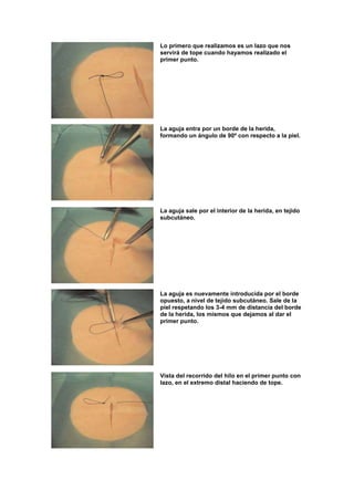 Lo primero que realizamos es un lazo que nos
servirá de tope cuando hayamos realizado el
primer punto.




La aguja entra por un borde de la herida,
formando un ángulo de 90º con respecto a la piel.




La aguja sale por el interior de la herida, en tejido
subcutáneo.




La aguja es nuevamente introducida por el borde
opuesto, a nivel de tejido subcutáneo. Sale de la
piel respetando los 3-4 mm de distancia del borde
de la herida, los mismos que dejamos al dar el
primer punto.




Vista del recorrido del hilo en el primer punto con
lazo, en el extremo distal haciendo de tope.
 