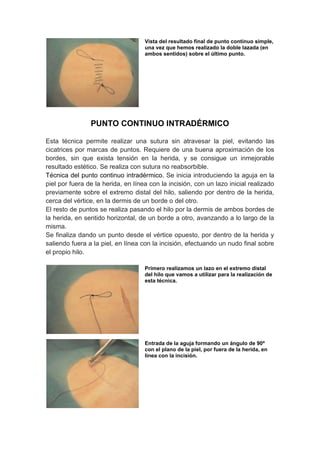 Vista del resultado final de punto continuo simple,
                                    una vez que hemos realizado la doble lazada (en
                                    ambos sentidos) sobre el último punto.




                PUNTO CONTINUO INTRADÉRMICO

Esta técnica permite realizar una sutura sin atravesar la piel, evitando las
cicatrices por marcas de puntos. Requiere de una buena aproximación de los
bordes, sin que exista tensión en la herida, y se consigue un inmejorable
resultado estético. Se realiza con sutura no reabsorbible.
Técnica del punto continuo intradérmico. Se inicia introduciendo la aguja en la
piel por fuera de la herida, en línea con la incisión, con un lazo inicial realizado
previamente sobre el extremo distal del hilo, saliendo por dentro de la herida,
cerca del vértice, en la dermis de un borde o del otro.
El resto de puntos se realiza pasando el hilo por la dermis de ambos bordes de
la herida, en sentido horizontal, de un borde a otro, avanzando a lo largo de la
misma.
Se finaliza dando un punto desde el vértice opuesto, por dentro de la herida y
saliendo fuera a la piel, en línea con la incisión, efectuando un nudo final sobre
el propio hilo.

                                    Primero realizamos un lazo en el extremo distal
                                    del hilo que vamos a utilizar para la realización de
                                    esta técnica.




                                    Entrada de la aguja formando un ángulo de 90º
                                    con el plano de la piel, por fuera de la herida, en
                                    línea con la incisión.
 