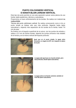 PUNTO COLCHONERO VERTICAL
              O DONATI-BLAIR-JORDAN VERTICAL
Este tipo de punto permite en una sola operación suturar varios planos de una
herida, tejido epidérmico, dérmico y subcutáneo.
Proporciona un buen enfrentamiento de los bordes. Se realiza con material no
reabsorbible.
Técnica del punto colchonero vertical. Se realiza comenzando como si de un
punto simple se tratase sólo que más profundo, llegando hasta tejido
subcutáneo y dejando más separación de los bordes de la herida, hasta 7-8
mm de ésta.
Se finaliza con el trayecto superficial de la sutura, con los puntos de entrada y
salida a 2-3 mm de dichos bordes, dejando los puntos primarios más distales
de la herida y en la misma vertical del trayecto profundo.

                                  Igual que en el punto simple, la aguja entra
                                  formando un ángulo de 90º con respecto al plano
                                  de la piel.




                                   La aguja sale igual que en el punto simple, pero
                                   más profunda, desde tejido subcutáneo.




                                   La aguja entra en el borde contrario, también al
                                   nivel del plano subcutáneo.
 