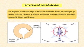 UBICACIÓN DE LOS DESGARROS:
Los desgarros se describen según la técnica del Cuadrante Horario de Lacassagne, que
permite ubicar los desgarros y describir su ubicación en el sentido horario, en números
romanos (de I hasta las XII horas).
 