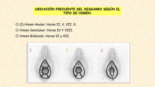 UBICACIÓN FRECUENTE DEL DESGARRO SEGÚN EL
TIPO DE HIMEN:
۞ (1) Himen Anular: Horas II, V, VII, X.
۞ Himen Semilunar: Horas IV Y VIII.
۞ Himen Bilabiado: Horas VI y XII.
 