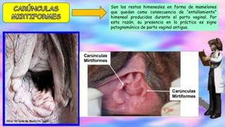 Son los restos himeneales en forma de mamelones
que quedan como consecuencia de “entallamiento”
himeneal producidos durante el parto vaginal. Por
esta razón, su presencia en la práctica es signo
patognomónico de parto vaginal antiguo.
 