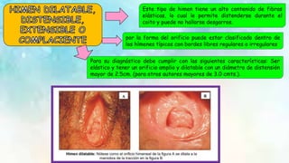 Este tipo de himen tiene un alto contenido de fibras
elásticas, lo cual le permite distenderse durante el
coito y puede no hallarse desgarros.
por la forma del orificio puede estar clasificado dentro de
los hímenes típicos con bordes libres regulares o irregulares
Para su diagnóstico debe cumplir con las siguientes características: Ser
elástico y tener un orificio amplio y dilatable con un diámetro de distensión
mayor de 2.5cm. (para otros autores mayores de 3.0 cmts.).
 