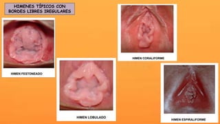 HIMENES TÍPICOS CON
BORDES LIBRES IREGULARES
 