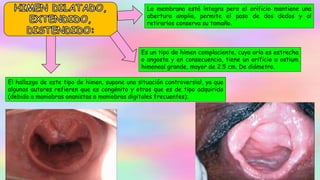 La membrana está íntegra pero el orificio mantiene una
abertura amplia, permite el paso de dos dedos y al
retirarlos conserva su tamaño.
Es un tipo de himen complaciente, cuya orla es estrecha
o angosta y en consecuencia, tiene un orificio u ostium
himeneal grande, mayor de 2.5 cm. De diámetro.
El hallazgo de este tipo de himen, supone una situación controversial, ya que
algunos autores refieren que es congénito y otros que es de tipo adquirido
(debido a maniobras onanistas o maniobras digitales frecuentes).
 